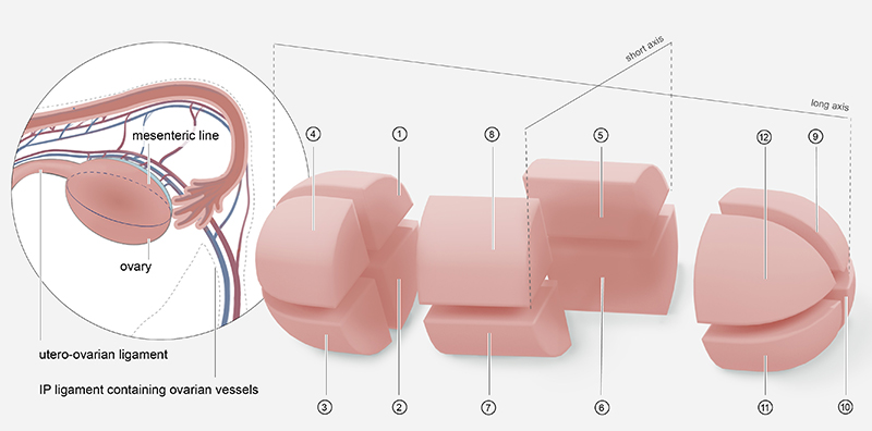 Ilustración que muestra el ovario, el ligamento uteroovárico, la línea mesentérica y el ligamento infundibulopélvico (IP) que contiene vasos ováricos. A la derecha, una representación de un ovario dividido en 12 zonas anatómicas a lo largo de sus ejes corto y largo.