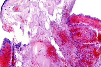 Corte microscópico de un quiste folicular roto.