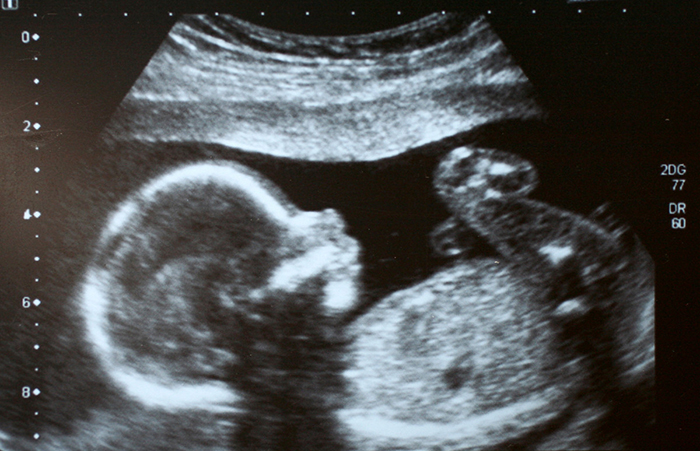 Imagen de ultrasonido de un feto humano.