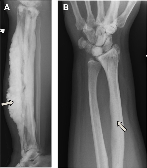 Imágenes de rayos X de huesos con melorreostosis, tanto en la forma tradicional de cera de vela derretida como en la forma vinculada a mutaciones en el gen SMAD3.