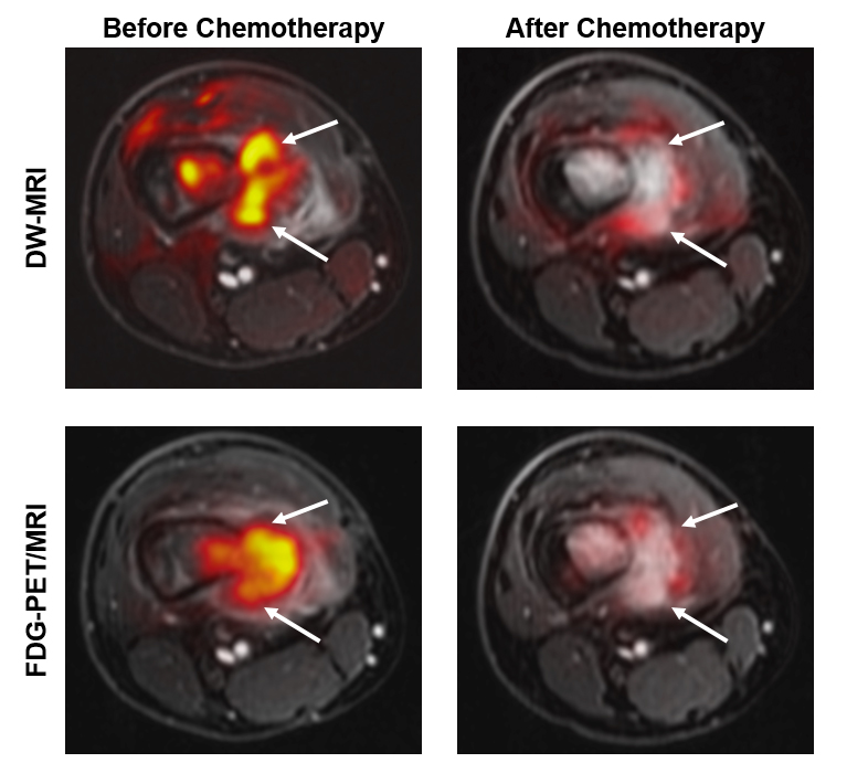 Imágenes de antes y después que muestran resultados similares de las resonancias magnéticas y las tomografías después de la quimioterapia para un tumor óseo.