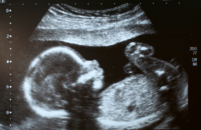Imagen de un ultrasonido de un feto.