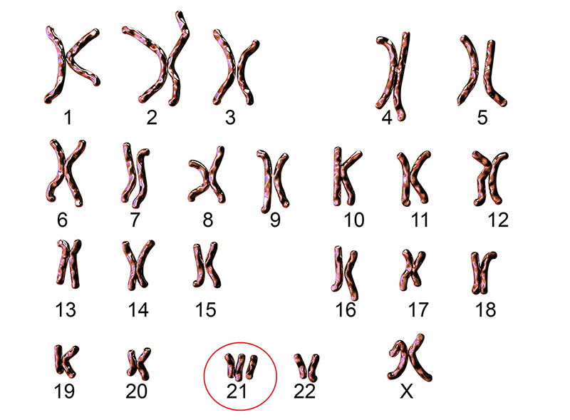 Un gráfico de cromosomas humanos que muestra el cromosoma 21 adicional presente en el síndrome de Down.