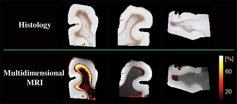 El panel superior, etiquetado como "histología", muestra tres secciones del cerebro con áreas marrones que indican astrogliosis. Debajo de una línea verde, el panel inferior, etiquetado como "resonancia magnética multidimensional", muestra las mismas tres secciones del cerebro con áreas de amarillo a rojo que indican astrogliosis. Aparece una barra de escala a la derecha.
