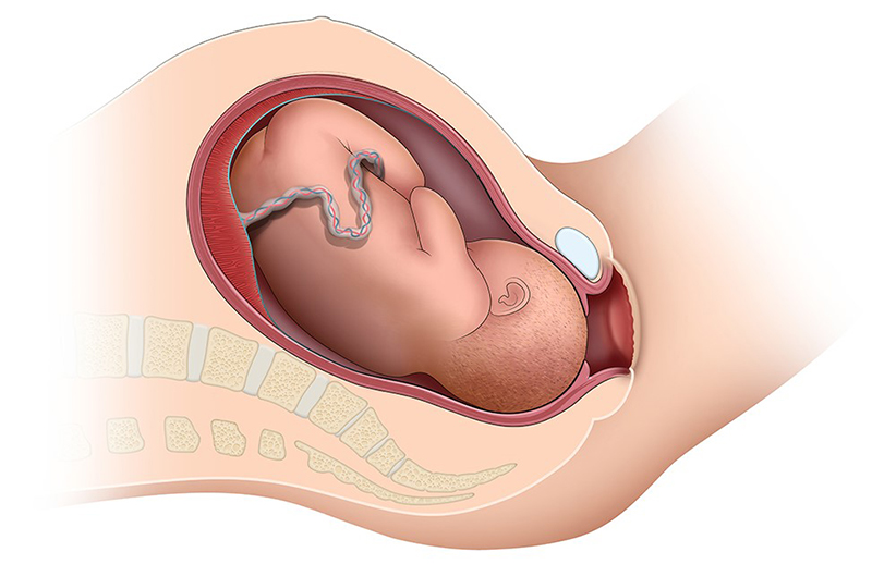 Gráfico seccionado del feto en el útero entrando al canal de parto.