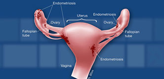 Gráfico de órganos reproductores femeninos con lesiones de endometriosis.