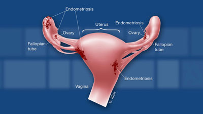 Gráfico de órganos reproductores femeninos con lesiones de endometriosis.