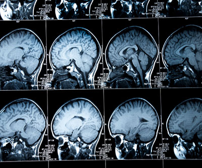 Una serie de escaneos cerebrales se muestran frente a una caja de luz.