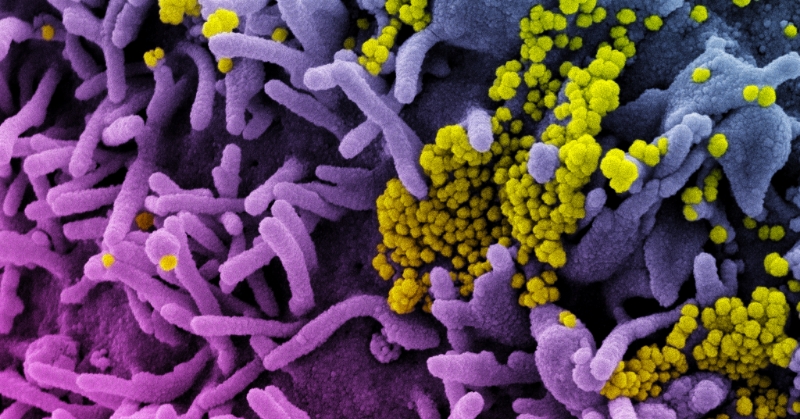Micrografía electrónica de escaneo a color de una célula (púrpura) infectada con el virus SARS-CoV-2 (amarillo).