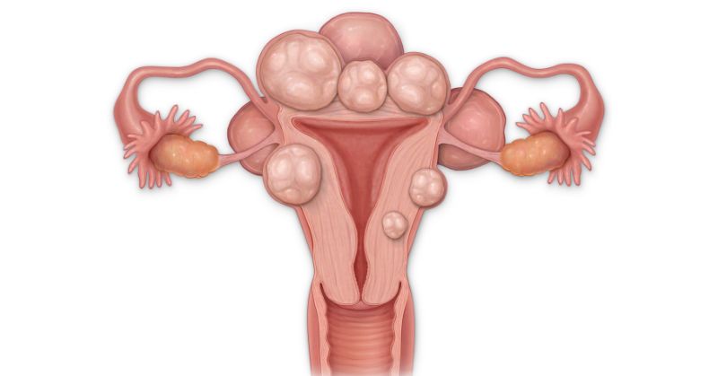 Gráfico de un útero con fibromas.