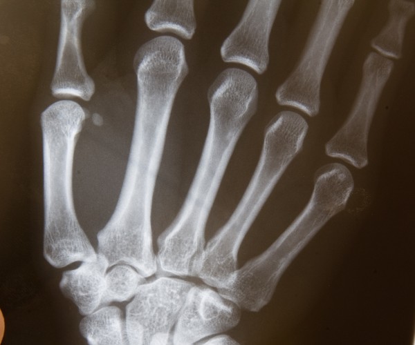 Radiografías de los huesos de la mano y la muñeca colocados contra una caja de luz.