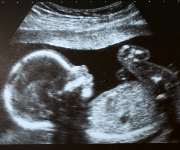 Una ecografía en blanco y negro de un feto de perfil.