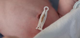 Sección media de un recién nacido que muestra el resto pinzado del cordón umbilical.