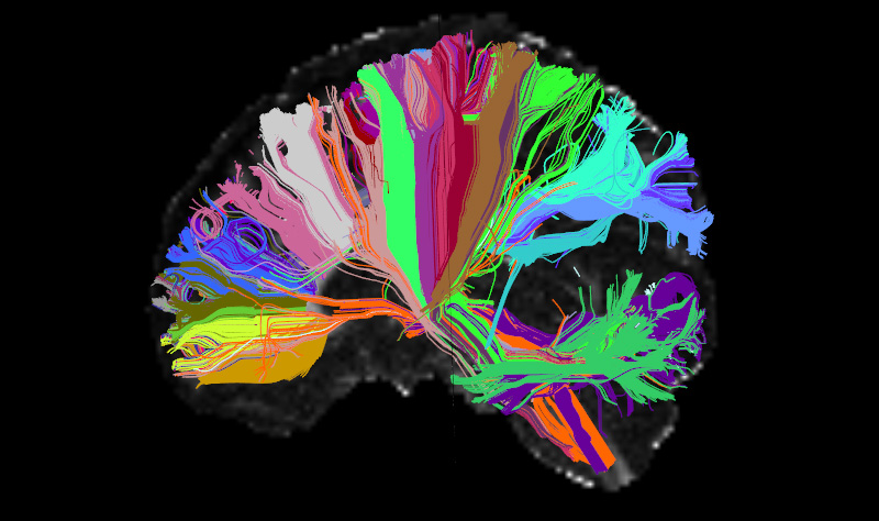 Conexiones de larga distancia en el cerebro humano. Los diferentes colores indican conexiones asociadas a diferentes estructuras del cerebro.
