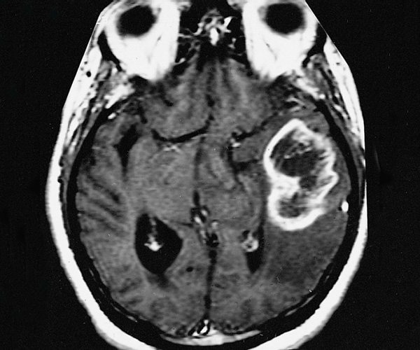 Imagen en escala de grises de un cerebro con un tumor que muestra una zona “circular” de realce del contraste alrededor de una zona central oscura.