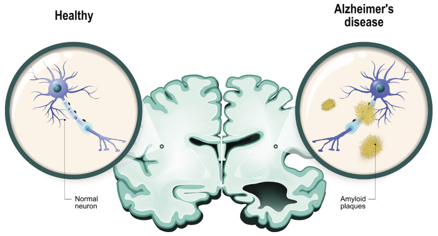 Ilustración de la diferencia entre las neuronas y el cerebro sanos (izquierda), y el cerebro y las neuronas en la enfermedad de Alzheimer (derecha). El lado derecho contiene placas de amiloide.