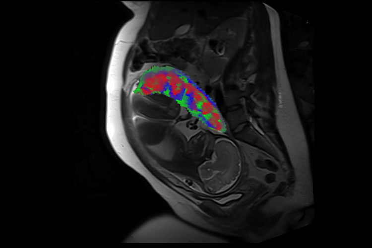 Un corte transversal de un abdomen humano con feto se muestra en blanco y negro, mientras que la placenta está en la parte superior del útero y se muestra en color.