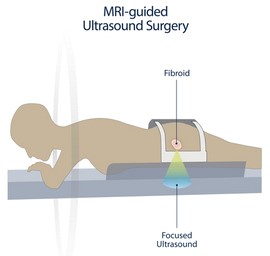 Un paciente que se somete a una cirugía de ultrasonido guiada por IRM yace boca abajo en un escáner de IRM. Se señaliza un fibroma y un ultrasonido enfocado en el abdomen del paciente.