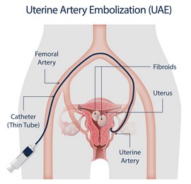 Se ilustra el procedimiento de embolización de la arteria uterina (EAU) en la silueta de un área pélvica. Se señaliza el catéter, la arteria femoral, los fibromas, el útero y la arteria uterina.