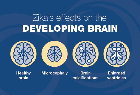 Infografía que muestra los efectos del Zika en un cerebro en desarrollo.