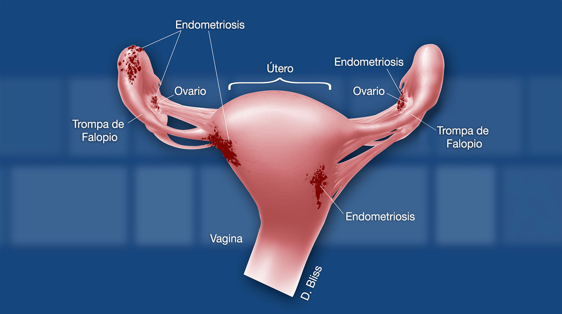 Los órganos reproductores femeninos se muestran con parches rojos de endometriosis ubicados en los ovarios y en el exterior del útero. El útero, las trompas de Falopio, los ovarios, la vagina y las áreas de endometriosis están etiquetados.