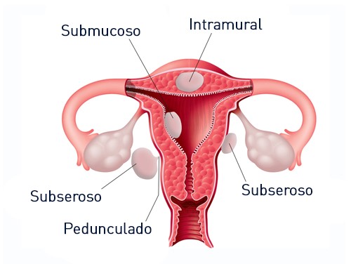Diferentes tipos de fibromas uterinos en diferentes lugares del útero. Etiquetas: fibroma intramural, subseroso, fibromas submucosos y pedúnculo.